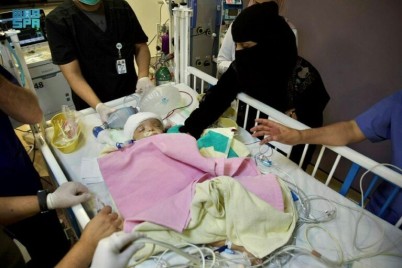 وفاة طفل من التوأم اليمني الملتصق بعد فصلهما
